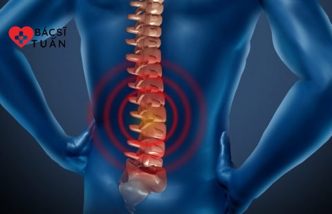 Nguyên nhân, triệu chứng, cách phòng bệnh đau thần kinh tọa